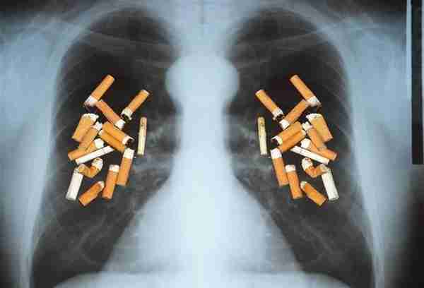 吸烟指数(肺癌高危人群的吸烟指数)